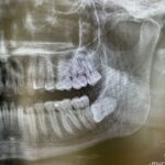 dente-giudizio-incluso