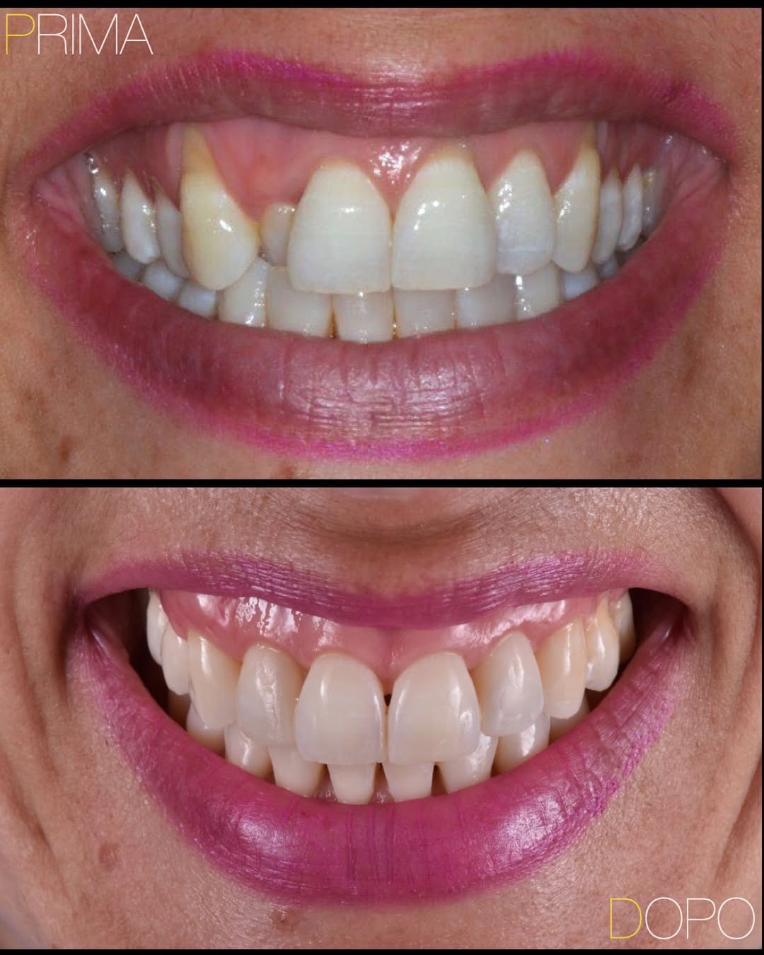 recessione-gengivale-caso-studio