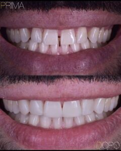 diastema-spazio-tra-i-denti
