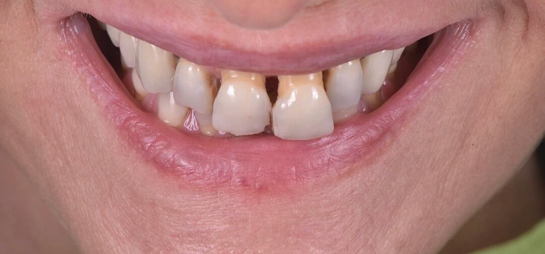 parodontite-estetica