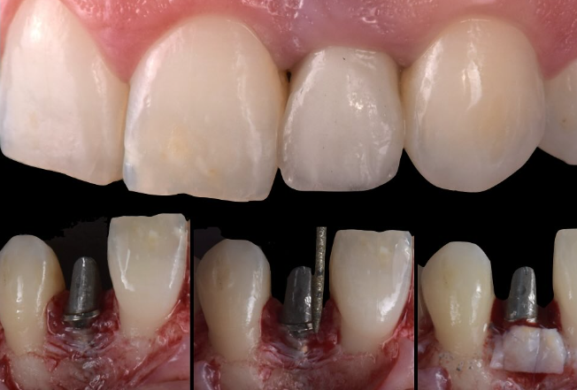 implantologia-muco-bopt-