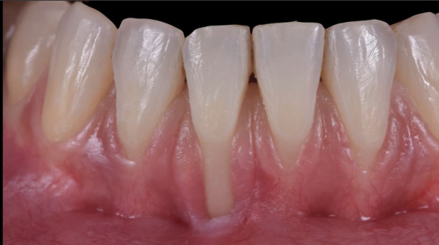 recessione-gengivale