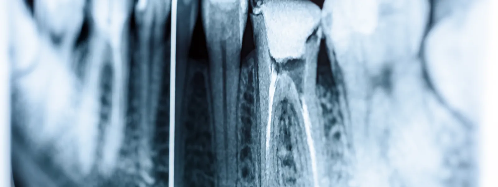 dente-devitalizzato
