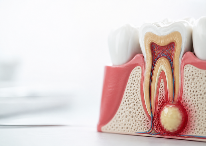 ascesso-dentale