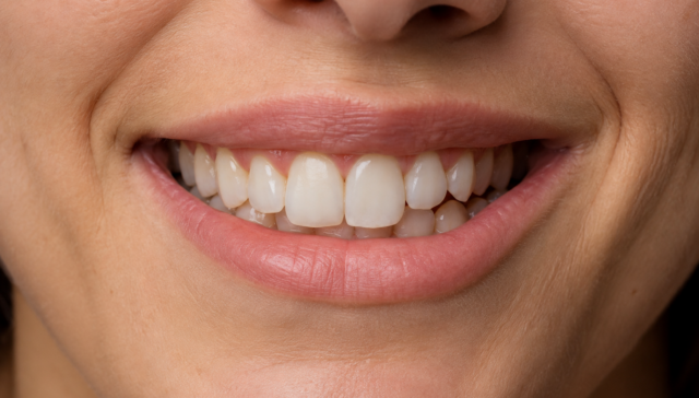 caso di sorriso asimmetrico